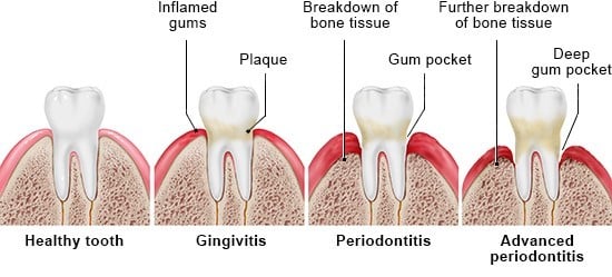 Progression of gum disease